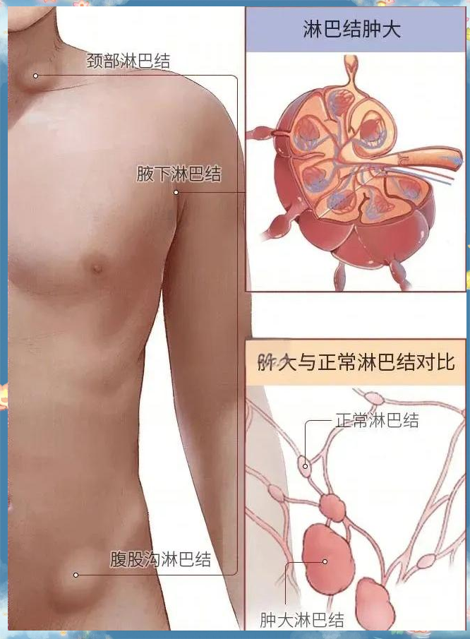 什么情况会染上鼠疫(怎么判断自己有没有鼠疫)