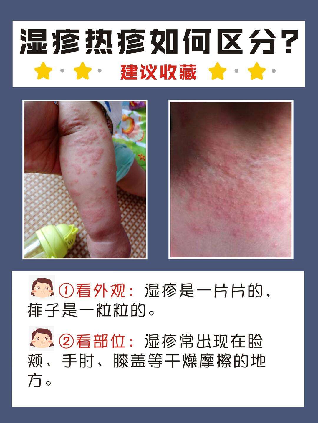 湿疹与热疹的区别图片(湿疹与热疹的区别图片宝宝)