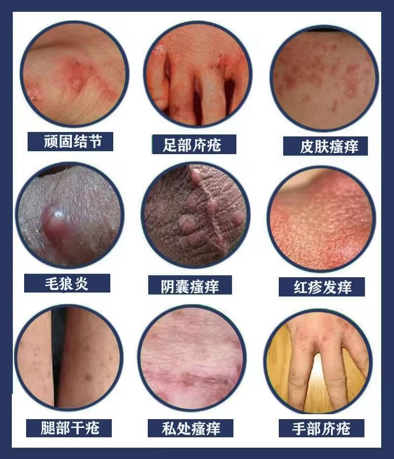 疥癣之疾(疥癣之疾的反义词)