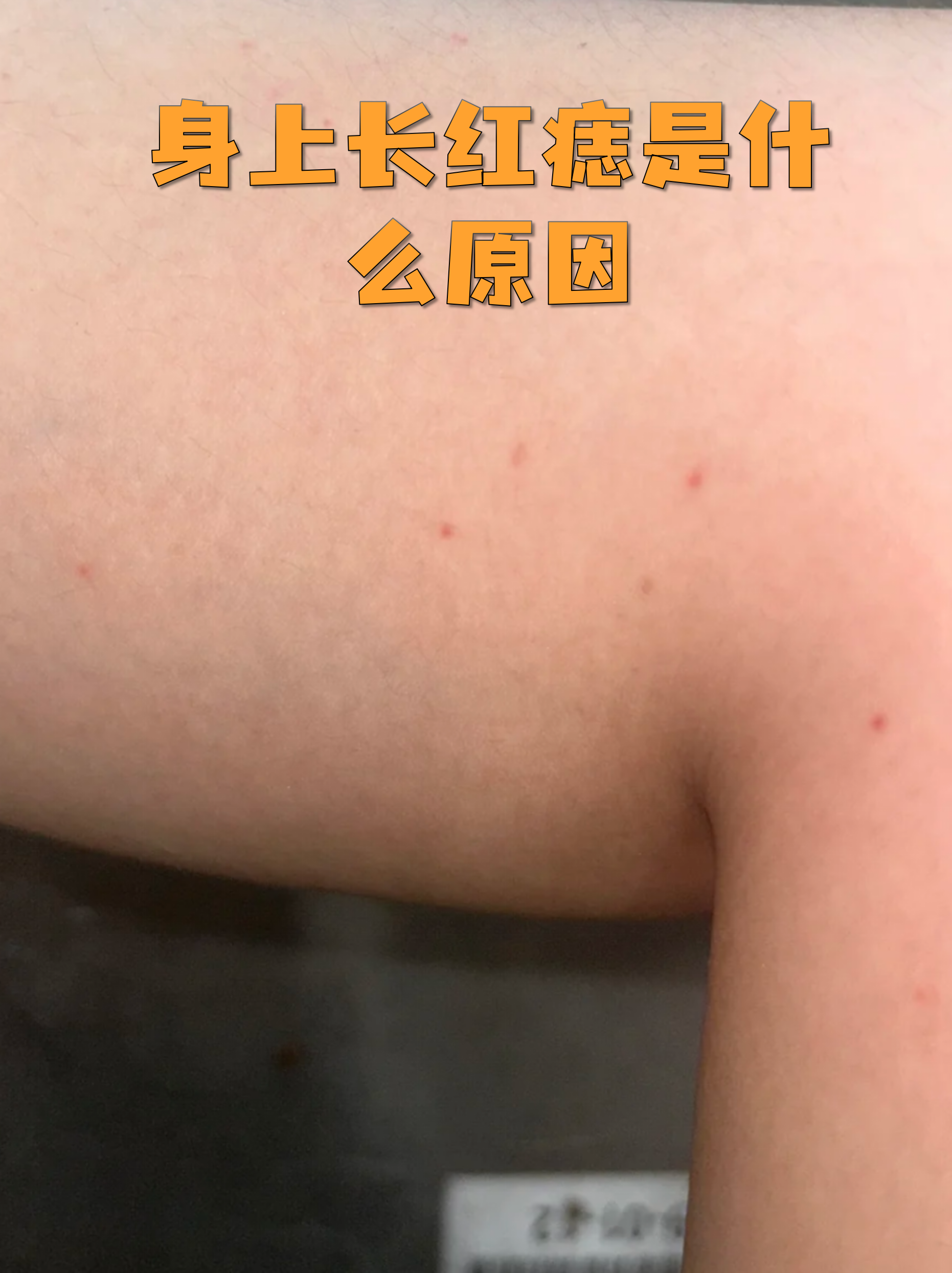 身上有红痣是什么情况(男人身上有红痣是什么情况) 身上有红痣是什么情况(男人身上有红痣是什么情况)