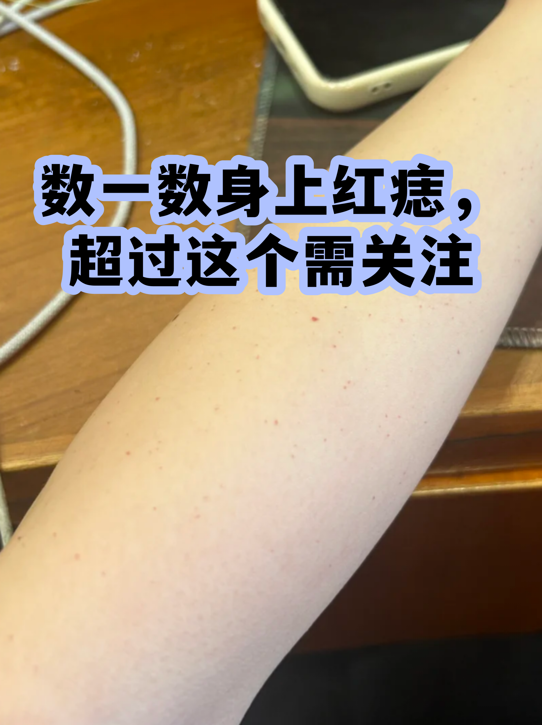 身上有红痣是什么情况(男人身上有红痣是什么情况) 身上有红痣是什么情况(男人身上有红痣是什么情况)