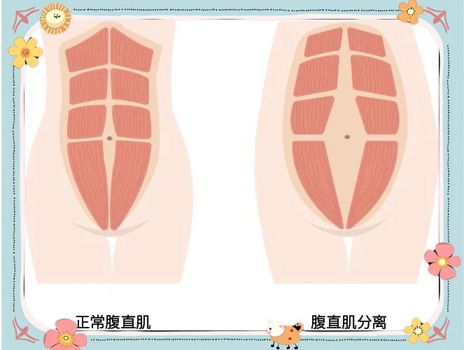 产后腹直肌分离自测图解(产后腹直肌分离诊疗专家共识) 产后腹直肌分离自测图解(产后腹直肌分离诊疗专家共识)