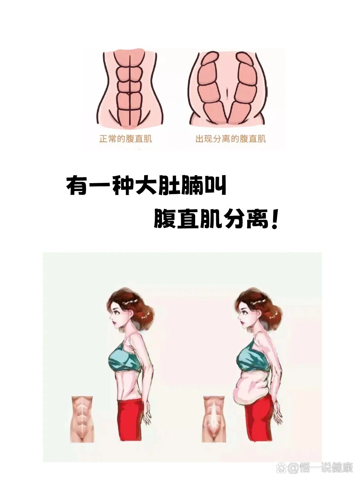 产后腹直肌分离自测图解(产后腹直肌分离诊疗专家共识) 产后腹直肌分离自测图解(产后腹直肌分离诊疗专家共识)