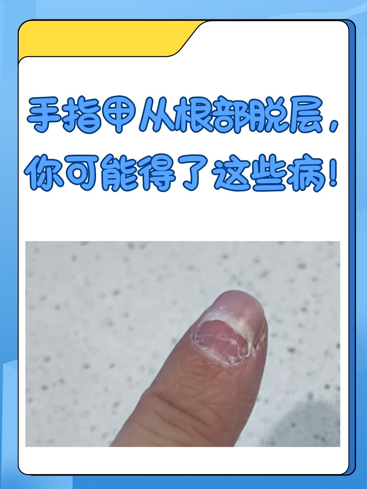 梦见指甲破裂是什么意思(梦见指甲破裂是什么意思啊)