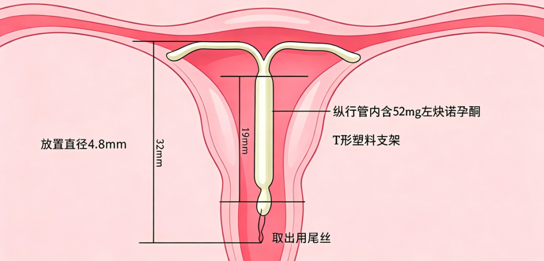 带曼月乐环的好处与坏处(带曼月乐对身体健康有影响吗) 带曼月乐环的好处与坏处(带曼月乐对身体健康有影响吗)