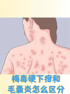 疳怎么读(疳积是什么意思)