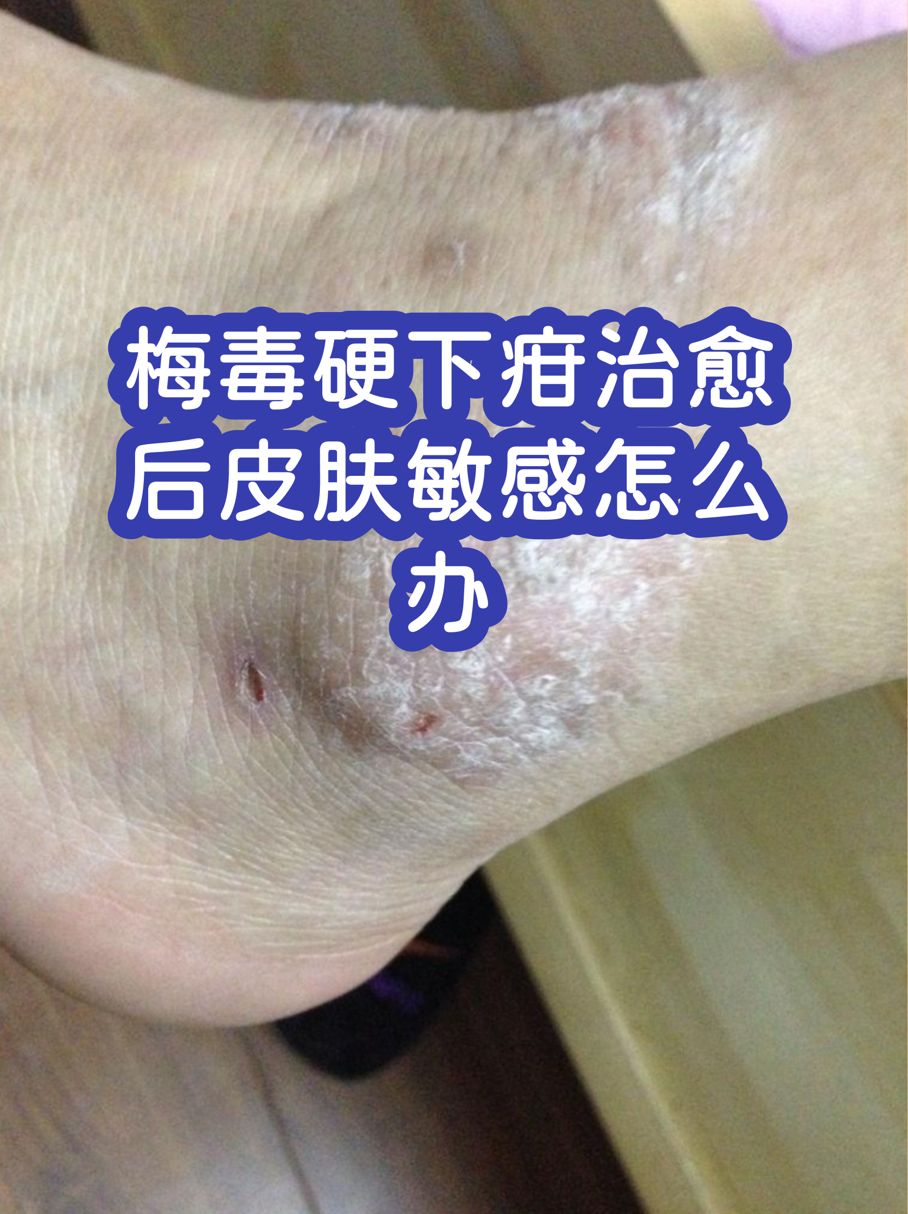 疳怎么读(疳积是什么意思) 疳怎么读(疳积是什么意思)