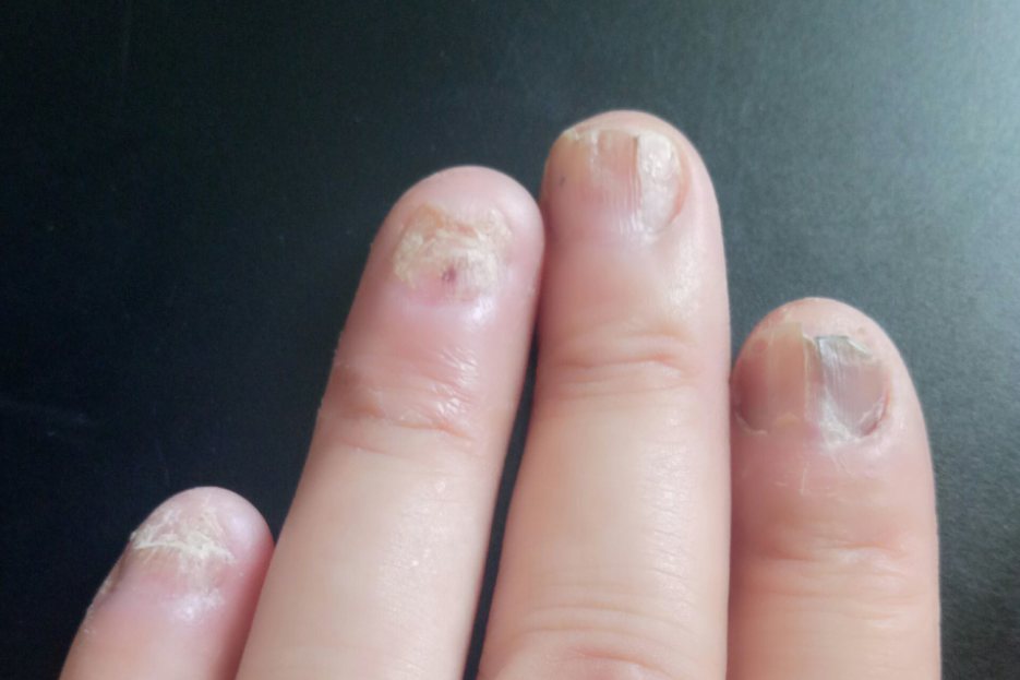 甲甲(甲甲状腺结节有什么症状)