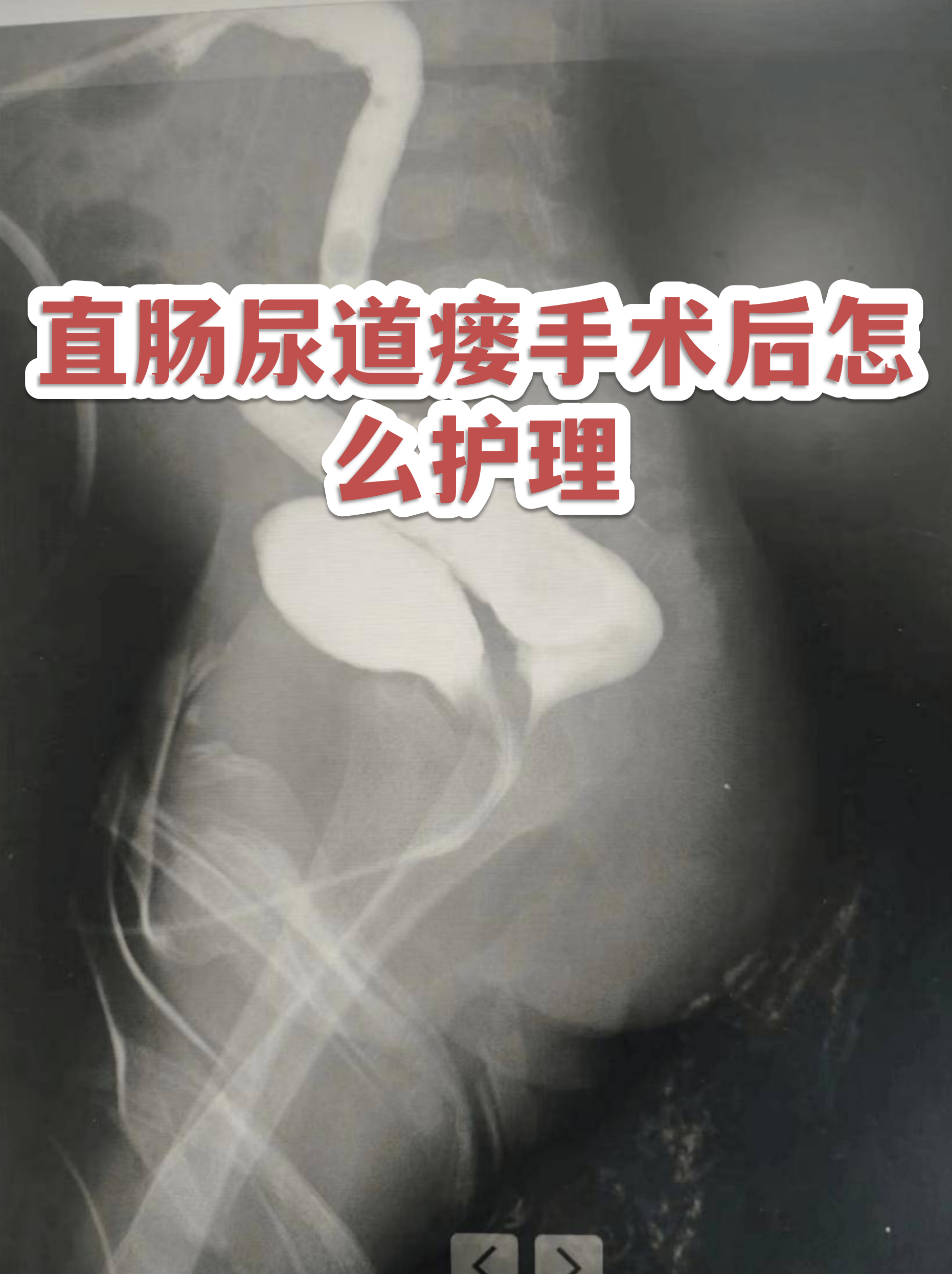 瘘怎么读(瘘怎么读?)