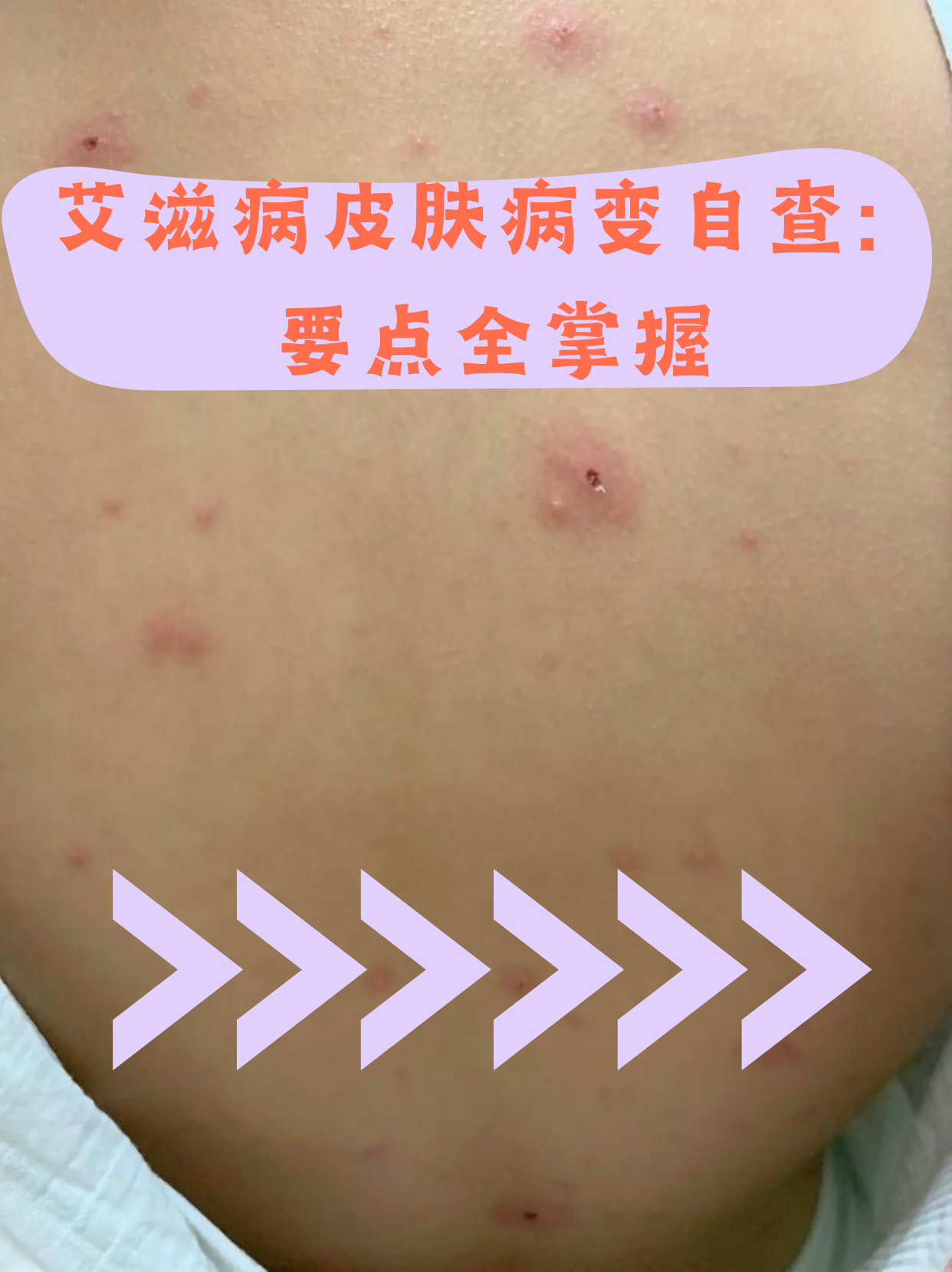 艾滋病红包图片(艾滋病红包会不会痒) 艾滋病红包图片(艾滋病红包会不会痒)